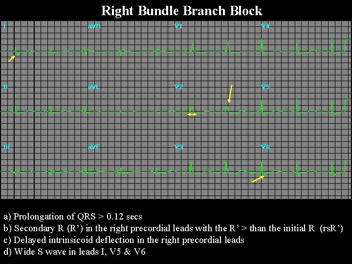Right Bundle Branch Block a) Prolongation of QRS > 0. 12 secs b) Secondary