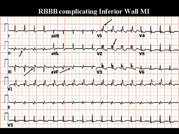  RBBB complicating Inferior Wall MI 