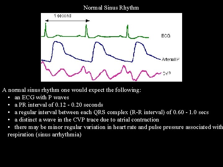 Normal Sinus Rhythm A normal sinus rhythm one would expect the following: • an