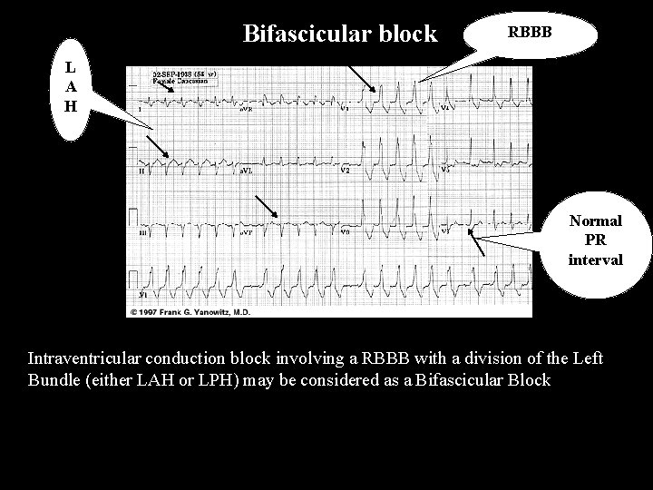 Bifascicular block RBBB L A H Normal PR interval Intraventricular conduction block involving a