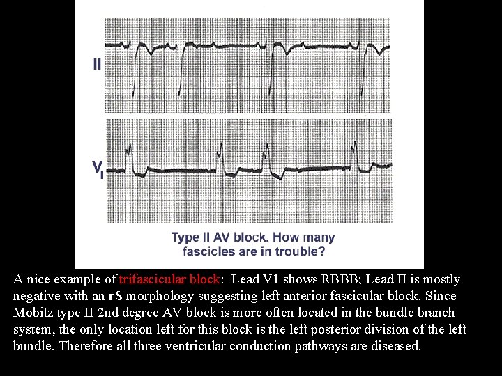 Trifascicular Block A nice example of trifascicular block: Lead V 1 shows RBBB; Lead