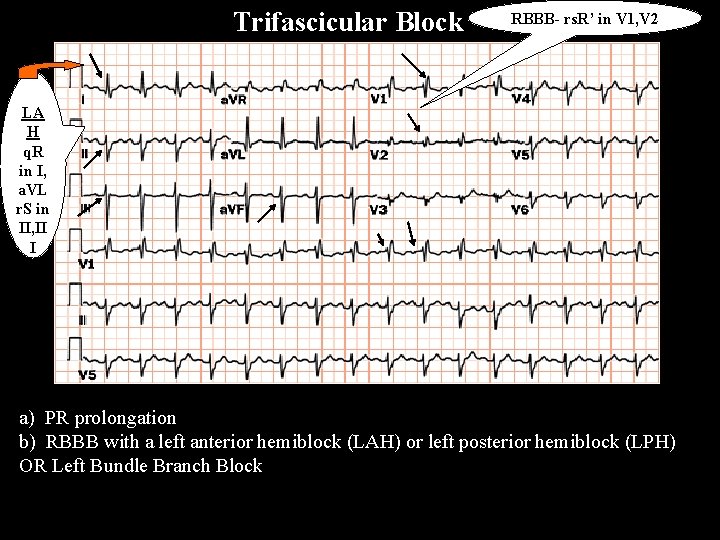 Trifascicular Block RBBB- rs. R’ in V 1, V 2 LA H q. R