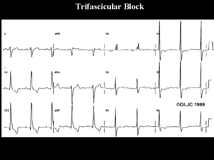 Trifascicular Block 