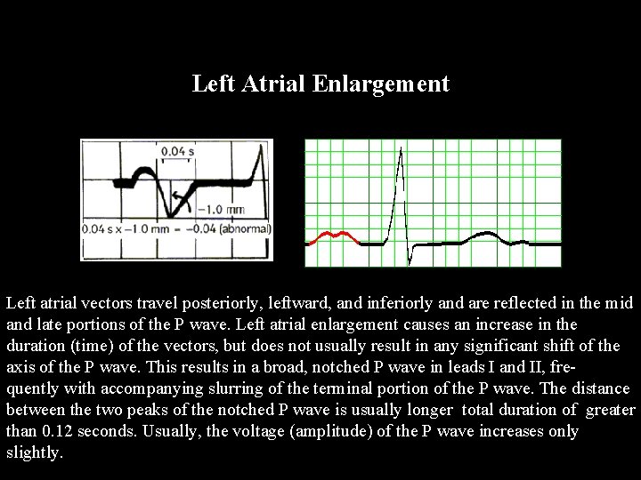 Left Atrial Enlargement Left atrial vectors travel posteriorly, leftward, and inferiorly and are reflected