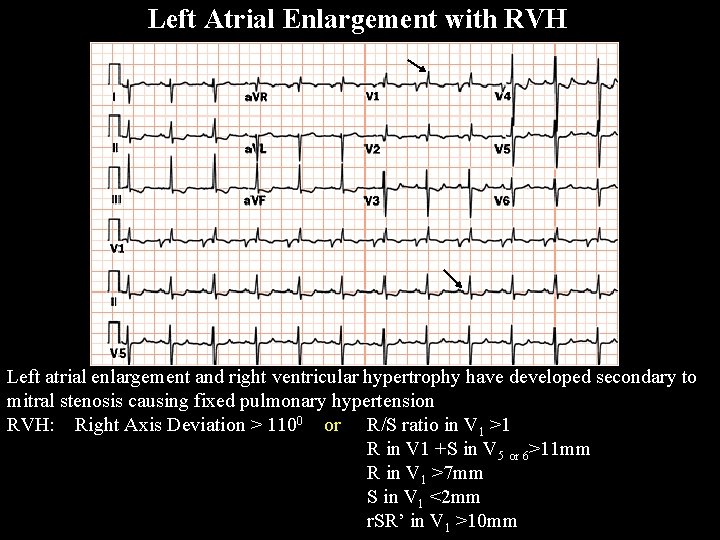 Left Atrial Enlargement with RVH Left atrial enlargement and right ventricular hypertrophy have developed