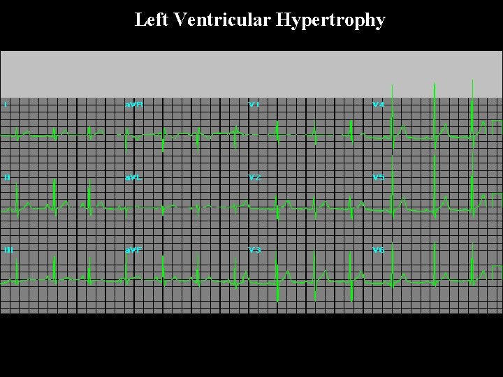 Left Ventricular Hypertrophy 