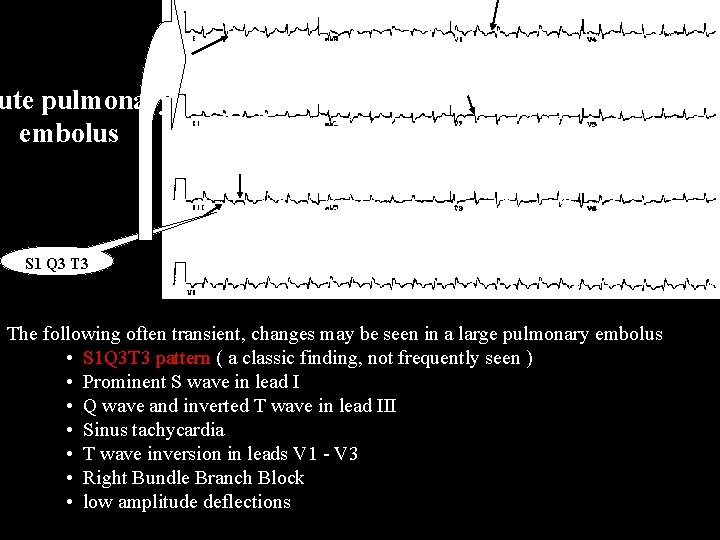 ute pulmonary embolus S 1 Q 3 The following often transient, changes may be
