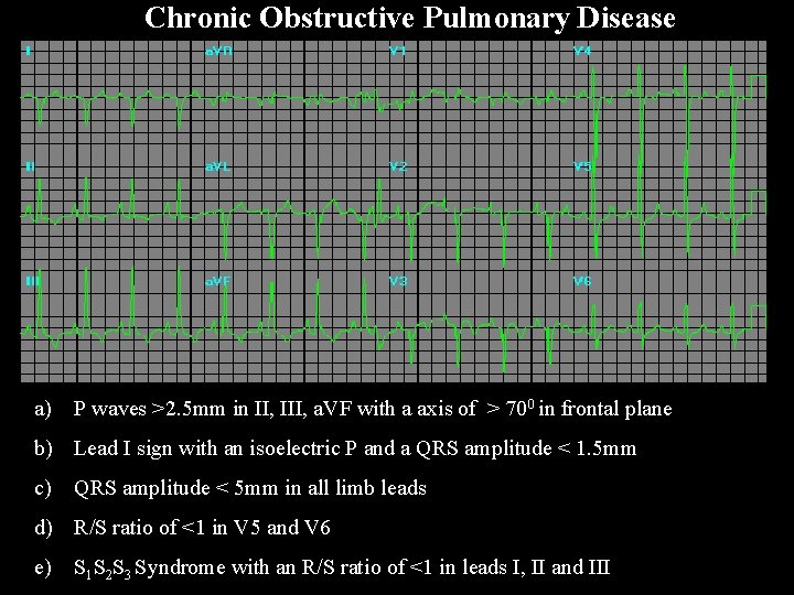 Chronic Obstructive Pulmonary Disease a) P waves >2. 5 mm in II, III, a.