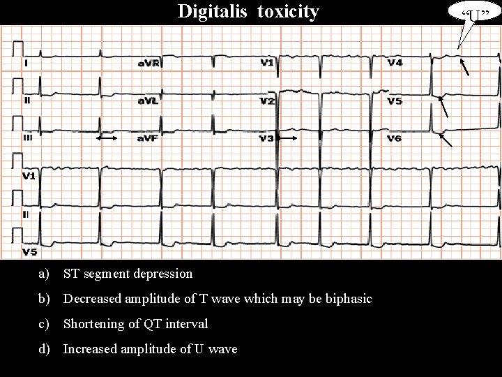 Digitalis toxicity a) ST segment depression b) Decreased amplitude of T wave which may