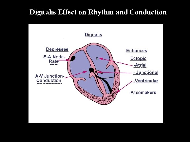 Digitalis Effect on Rhythm and Conduction 