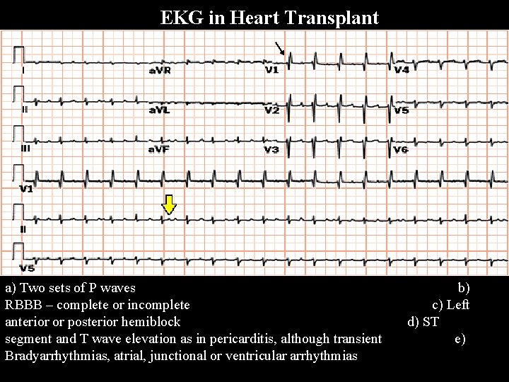 EKG in Heart Transplant a) Two sets of P waves b) RBBB – complete