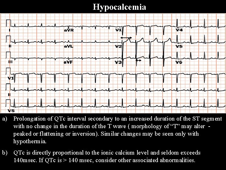 Hypocalcemia a) Prolongation of QTc interval secondary to an increased duration of the ST