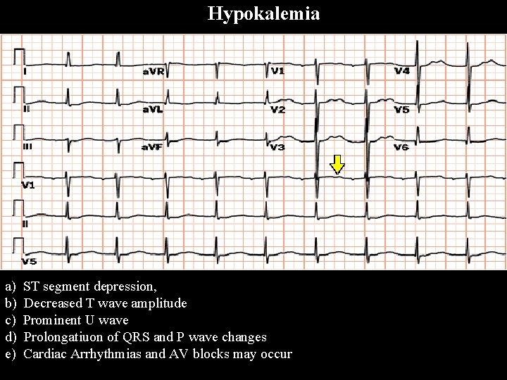 Hypokalemia a) ST segment depression, b) Decreased T wave amplitude c) Prominent U wave