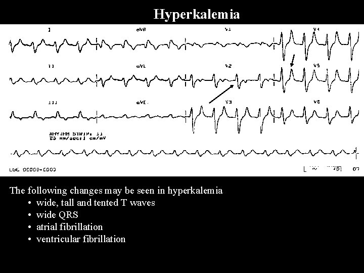 Hyperkalemia The following changes may be seen in hyperkalemia • wide, tall and tented