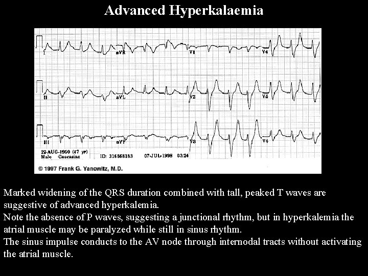 Advanced Hyperkalaemia Marked widening of the QRS duration combined with tall, peaked T waves