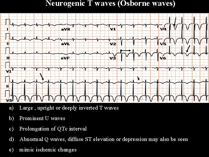Neurogenic T waves (Osborne waves) a) Large , upright or deeply inverted T waves