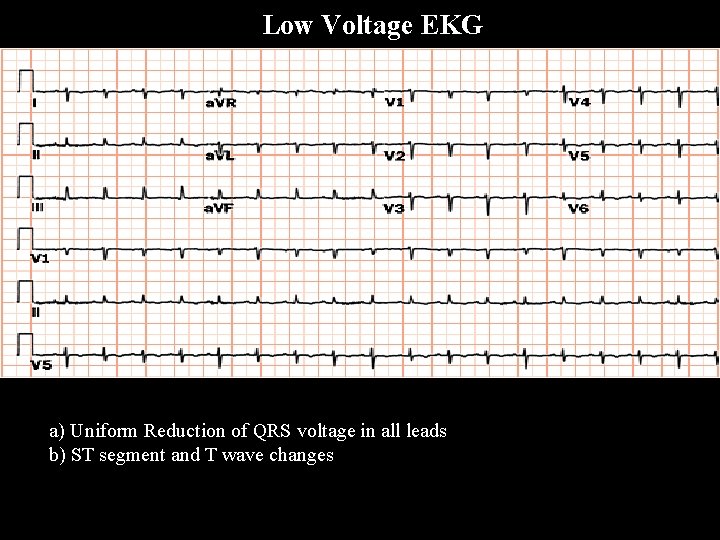  Low Voltage EKG a) Uniform Reduction of QRS voltage in all leads b)