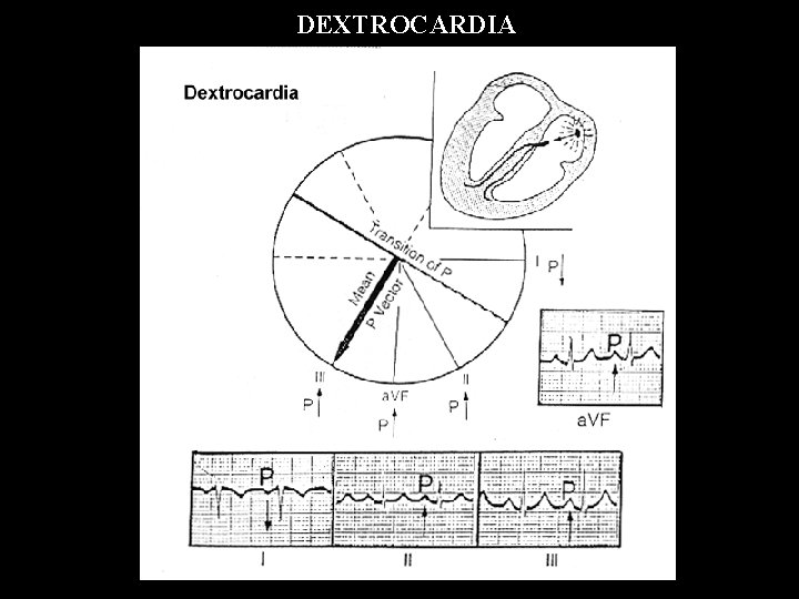 DEXTROCARDIA 