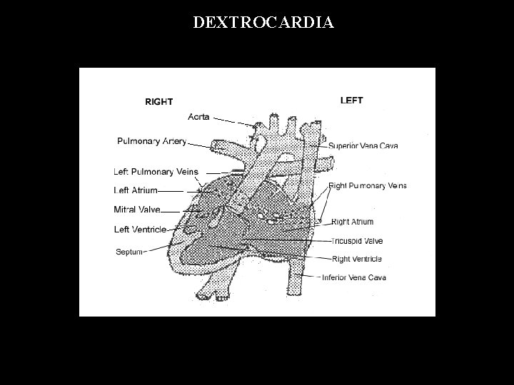  DEXTROCARDIA 