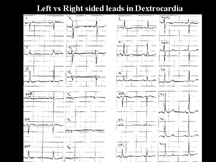 Left vs Right sided leads in Dextrocardia 