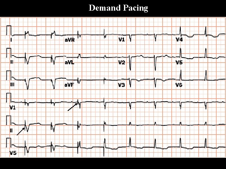 Demand Pacing 