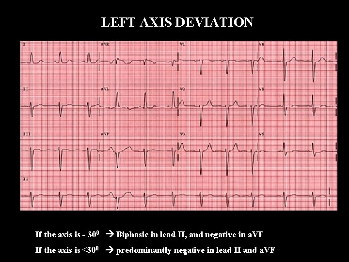 LEFT AXIS DEVIATION If the axis is - 300 Biphasic in lead II, and