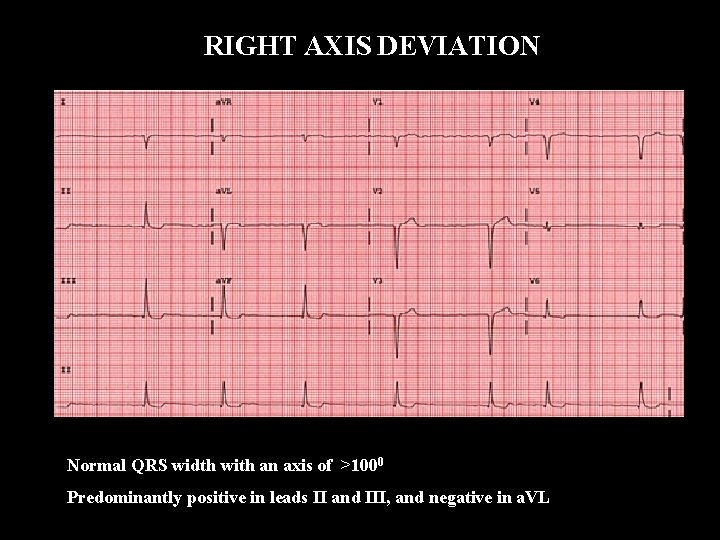 RIGHT AXIS DEVIATION Normal QRS width with an axis of >1000 Predominantly positive in