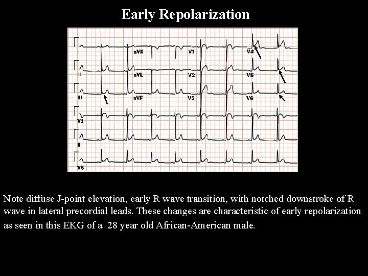 Early Repolarization Note diffuse J-point elevation, early R wave transition, with notched downstroke of