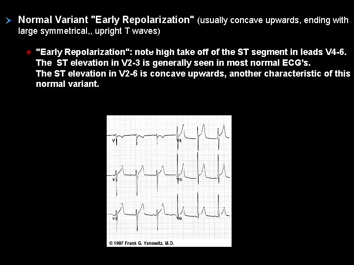 Normal Variant "Early Repolarization" (usually concave upwards, ending with large symmetrical, , upright T