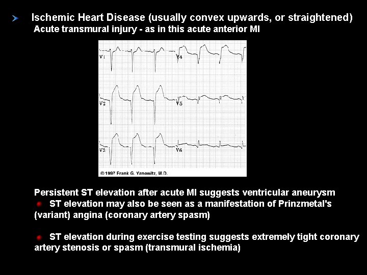 Ischemic Heart Disease (usually convex upwards, or straightened) Acute transmural injury - as in