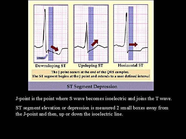 J-point is the point where S wave becomes isoelectric and joins the T wave.