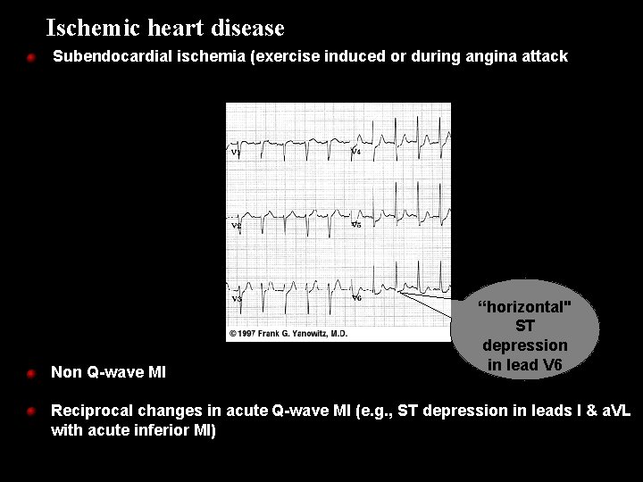 Ischemic heart disease Subendocardial ischemia (exercise induced or during angina attack Non Q-wave MI