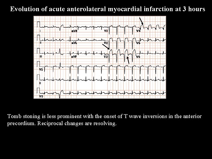 Evolution of acute anterolateral myocardial infarction at 3 hours Tomb stoning is less prominent