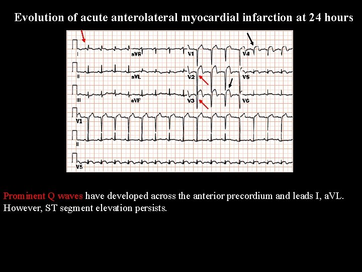 Evolution of acute anterolateral myocardial infarction at 24 hours Prominent Q waves have developed