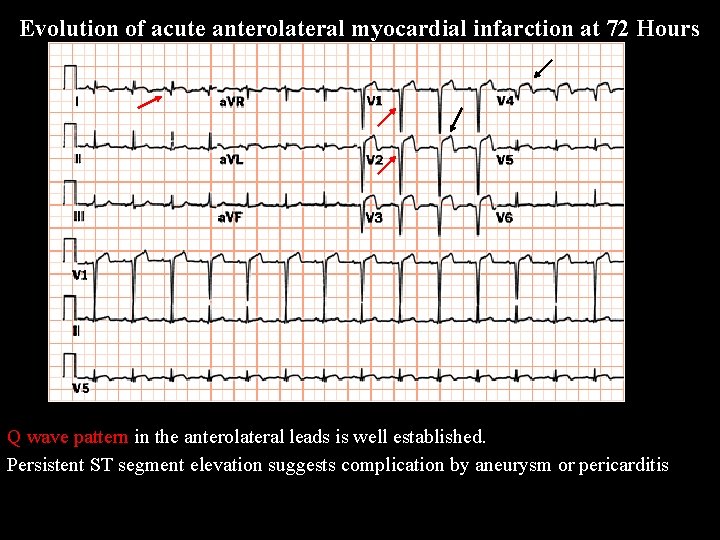 Evolution of acute anterolateral myocardial infarction at 72 Hours Q wave pattern in the
