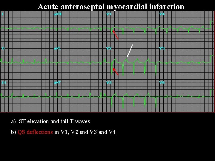 Acute anteroseptal myocardial infarction a) ST elevation and tall T waves b) QS deflections