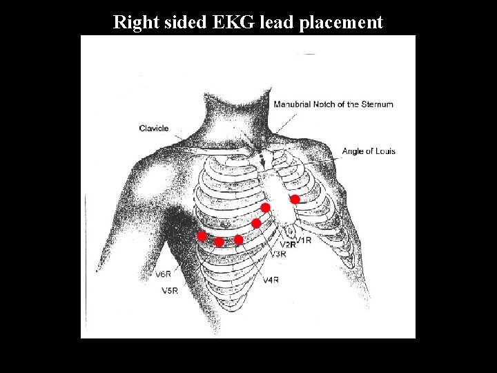 Right sided EKG lead placement 