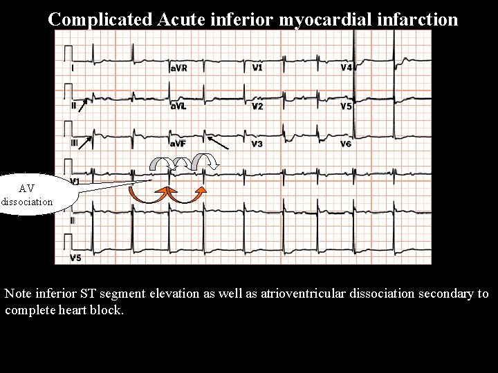 Complicated Acute inferior myocardial infarction AV dissociation Note inferior ST segment elevation as well