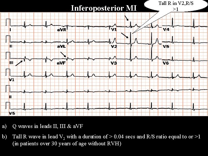 Inferoposterior MI Tall R in V 2, R/S >1 a) Q waves in leads