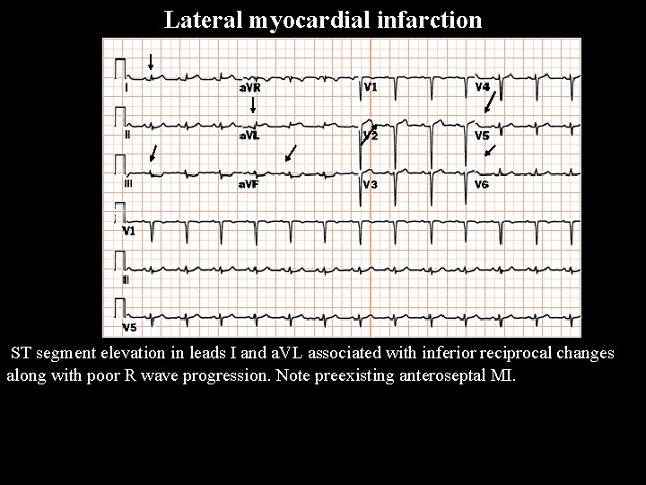 Lateral myocardial infarction ST segment elevation in leads I and a. VL associated with