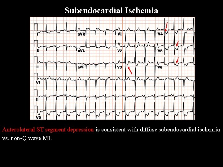 Subendocardial Ischemia Anterolateral ST segment depression is consistent with diffuse subendocardial ischemia vs. non-Q