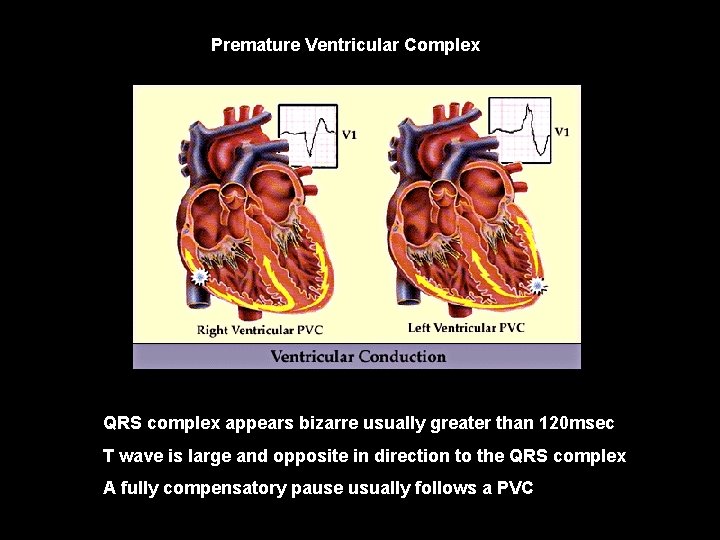 Premature Ventricular Complex P V C QRS complex appears bizarre usually greater than 120