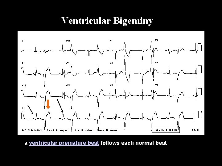 Ventricular Bigeminy a ventricular premature beat follows each normal beat Bi ge mi ny