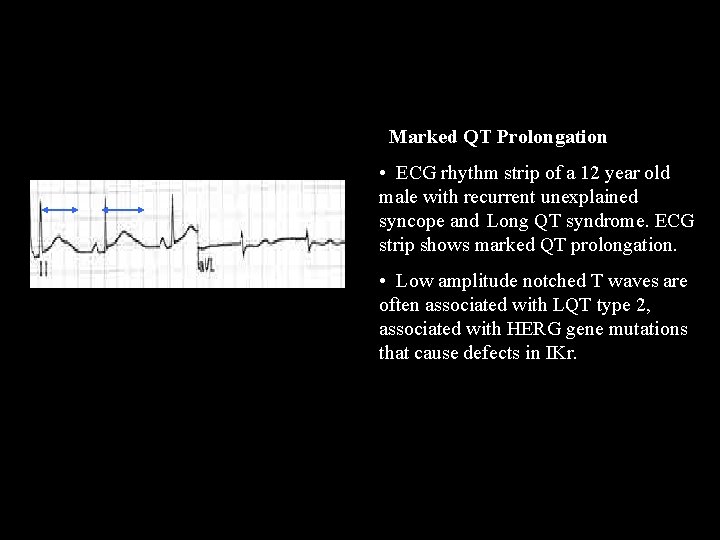 QT prolongation Marked QT Prolongation • ECG rhythm strip of a 12 year old