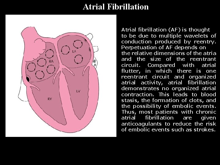 A F i b Atrial Fibrillation Atrial fibrillation (AF) is thought to be due
