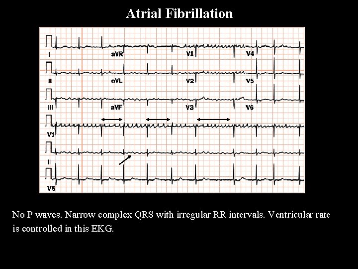 Atrial Fibrillation A F i b No P waves. Narrow complex QRS with irregular