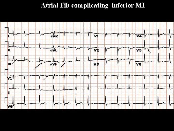 Atrial Fib complicating inferior MI A F i b 