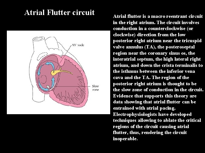 A F l u t t Atrial Flutter circuit Atrial flutter is a macro