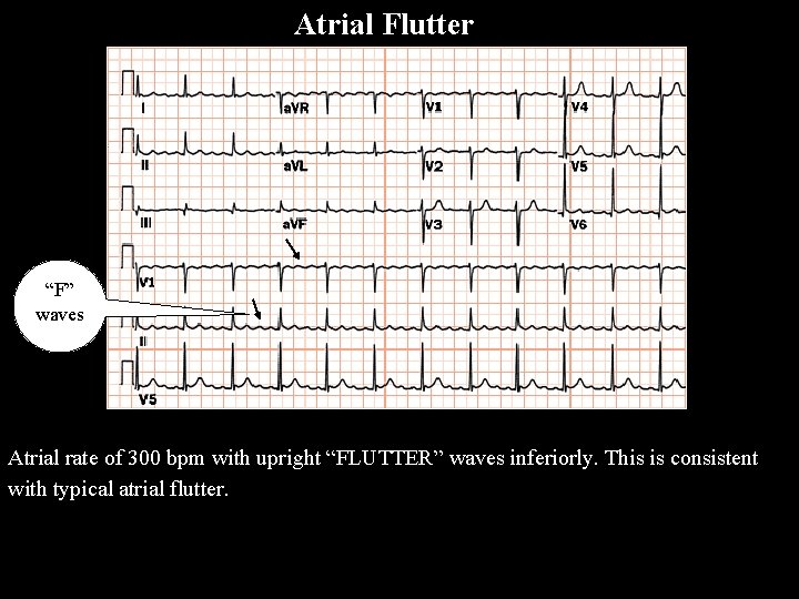 Atrial Flutter A F l u t t e r “F” waves Atrial rate
