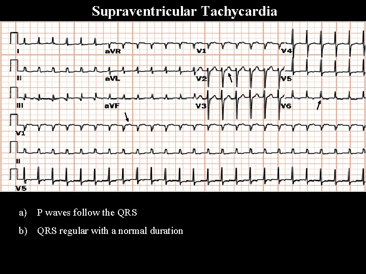 a) P waves follow the QRS b) QRS regular with a normal duration S